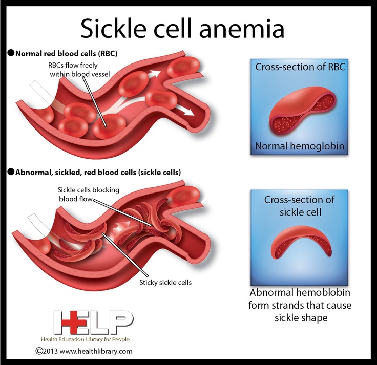 people with sickle cell anemia